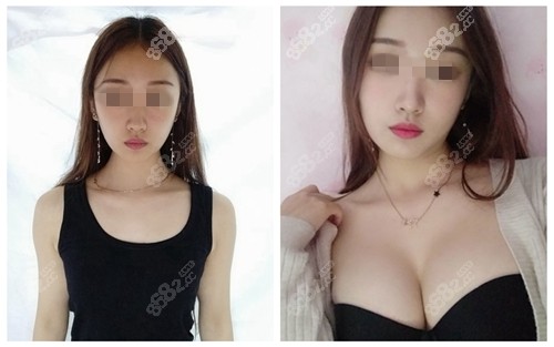 杭州美莱假体隆胸案例