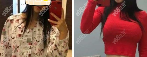 广州韩后整形做傲诺拉隆胸前后对比