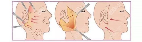 4stcm面部提升术原理