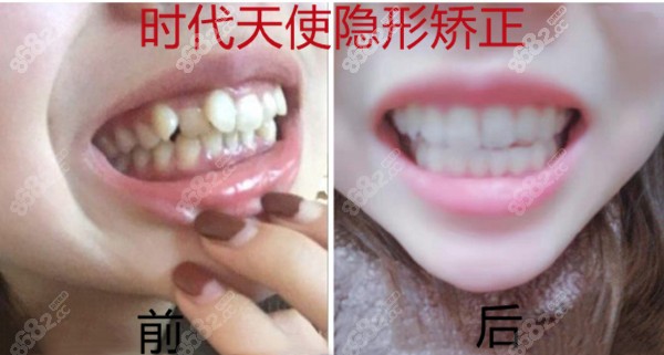 天津美奥时代天使隐形矫正案例