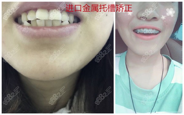 天津美奥金属托槽矫正案例