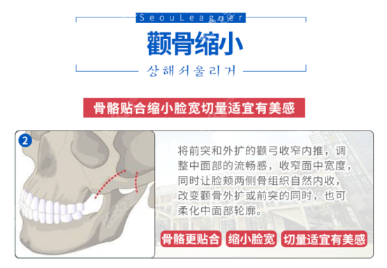 <!--<i data=20240705-sp></i>-->医生颧骨磨骨优势