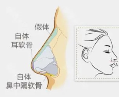 隆鼻前你要知道些什么：做鼻子哪种材质好,自体骨隆鼻好吗