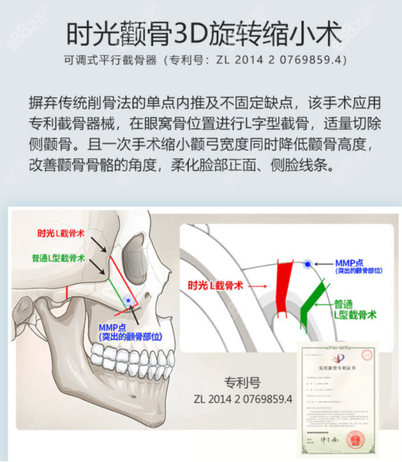 上海时光做颧骨内推的优势