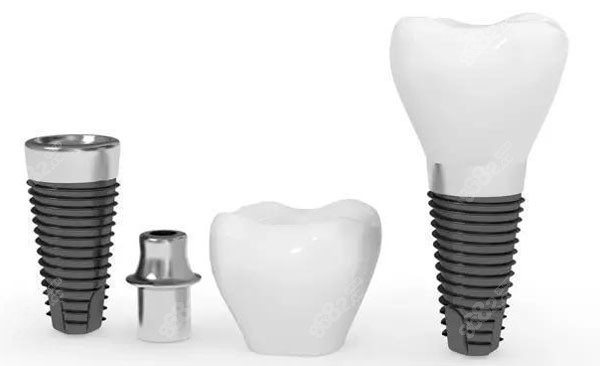 無錫北極星口腔的種植牙價(jià)格 無錫北極星口腔的種植牙價(jià)格