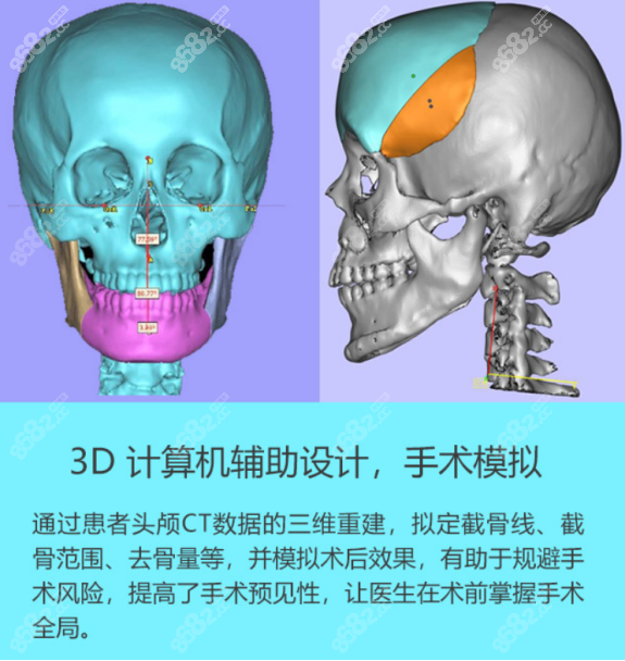 上海时光做下颌角的优势