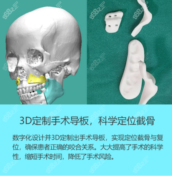 上海时光可以预知磨骨后的效果