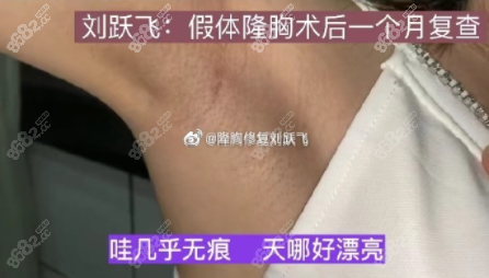 刘跃飞医生假体隆胸术后一个月疤痕恢复情况