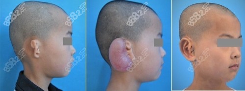 中国医学科学院北京八大处医院蒋海越全耳再造术案例效果图