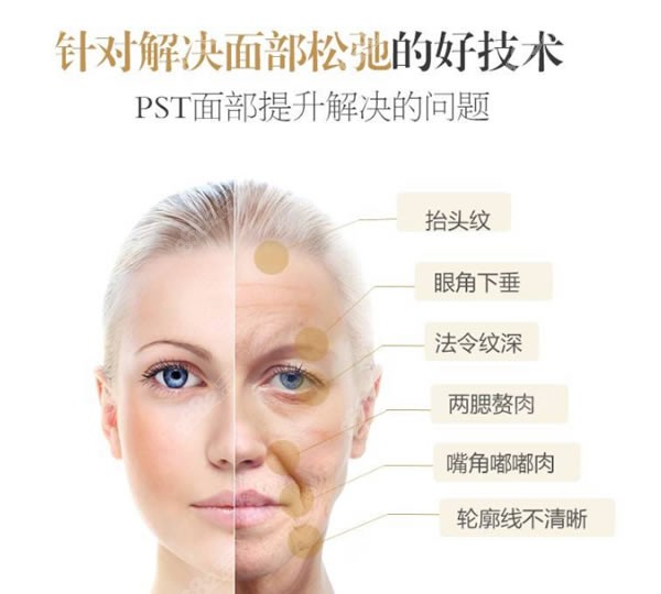 pst面部提升可以改善哪些面部问题