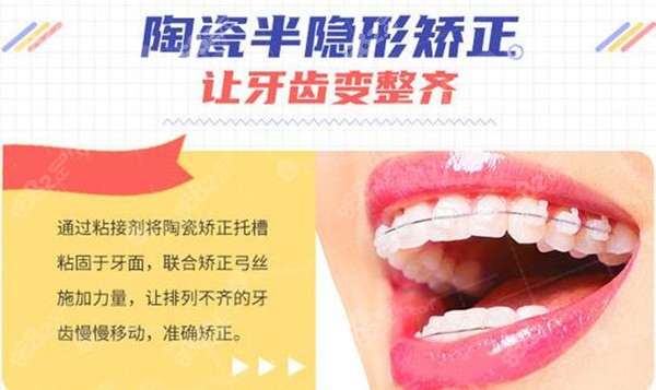 西安戴牙套一般多少钱