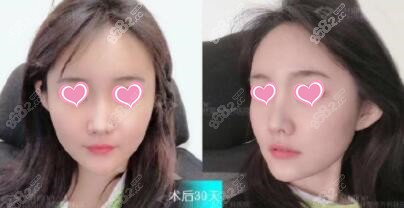 自体脂肪填充面部术后30天照