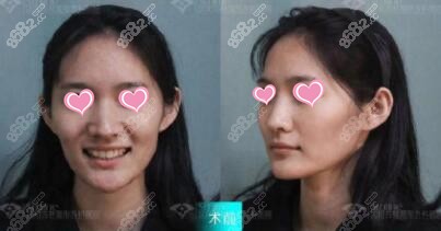 自体脂肪填充术前照