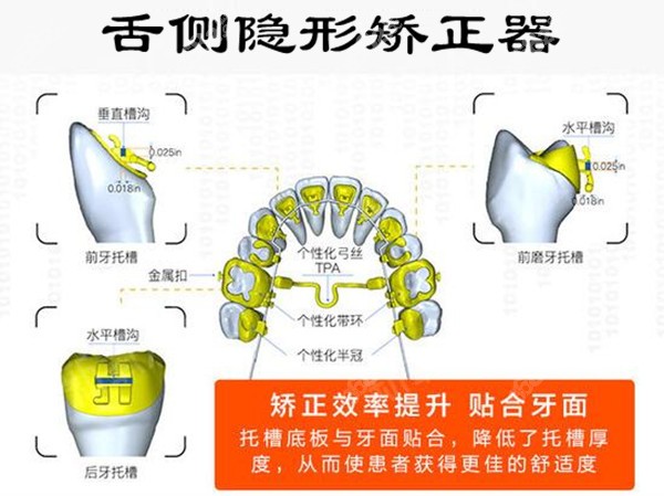 西安牙齿矫正大概要花费多少钱
