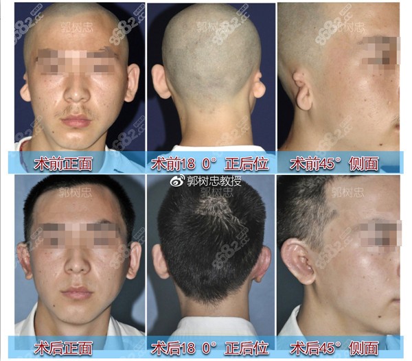 <!--<i data=20240705-sp></i>-->做一只人造耳朵案例