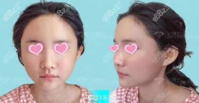 自体脂肪填充面部术后3天照