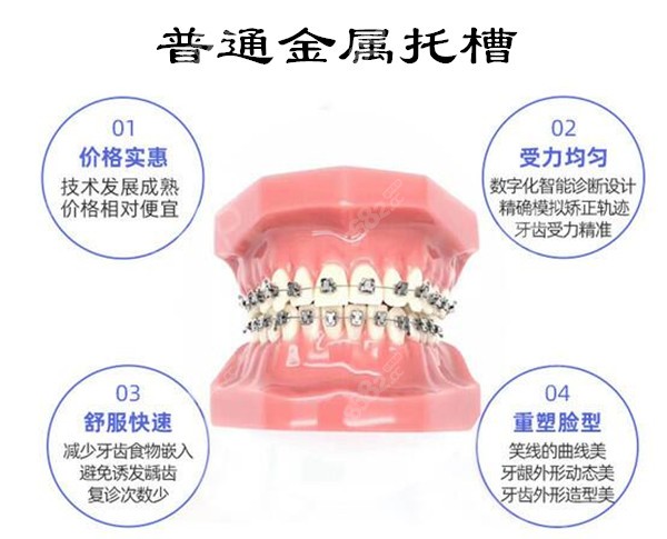 西安传统金属托槽价格
