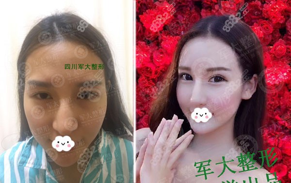 成都做脂肪填充有名的<!--<i data=20240705-sp></i>-->真人案例