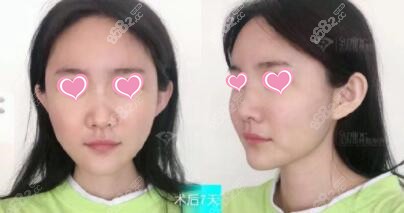 自体脂肪填充全脸术后7天照