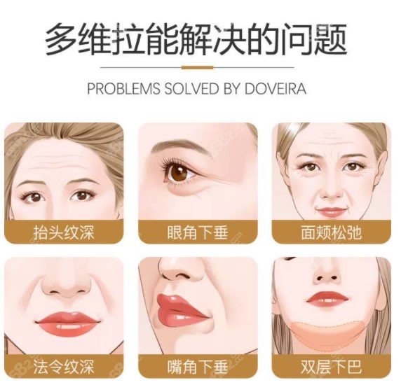 多维拉拉皮除皱术适合哪些部位