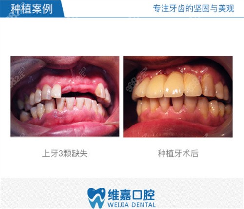 北京维嘉口腔种植牙<span style=