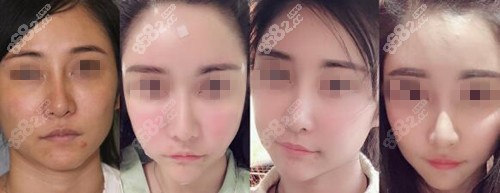 怀化天姿整形医院脂肪填充真人案例照