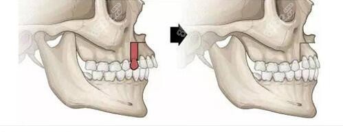 骨性凸嘴做正颌手术矫正脸型原理
