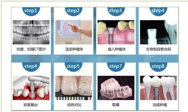 种植牙的流程图