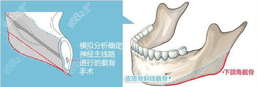 下颌骨3D缩小术