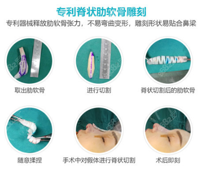 脊?fàn)罾哕浌菍Ｓ袕?fù)合隆鼻操作過程