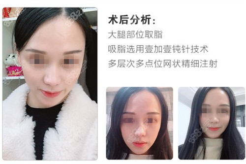 西安艺星整形医院额头自体脂肪填充<span style=