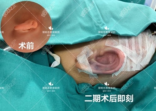 西安国医<!--<i data=20240705-sp></i>-->小耳畸形矫正案例前后对比