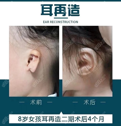 河南整形张正文耳再造案例