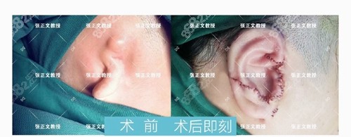 河南整形张正文小耳畸形矫正案例