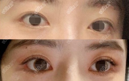 双眼皮不对称修复后对比