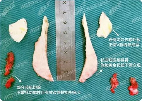 重庆爱思特医生通过截骨量和线条微调尽量达到双侧对称协调