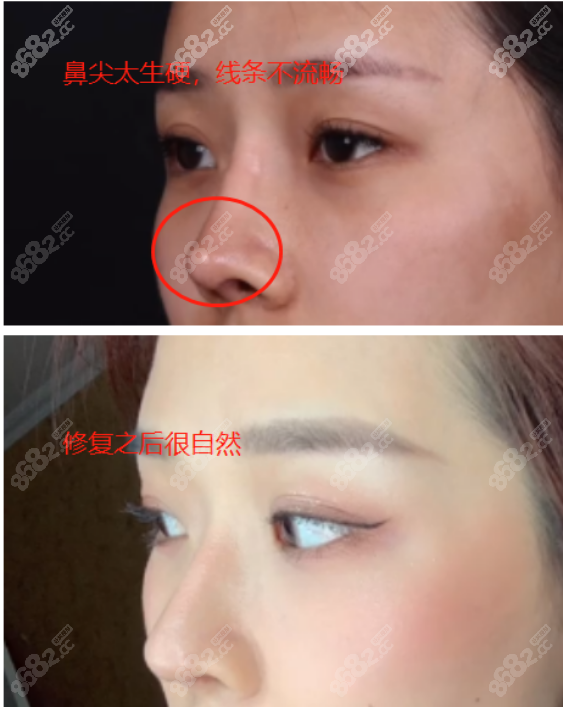 李炳浍鼻修复的图片