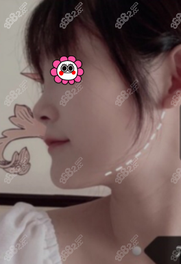 花4万多在广州广大做的下颌角<span style=