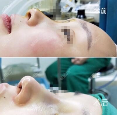 <!--<i data=20240705-sp></i>-->做鼻综合真人前后对比效果照