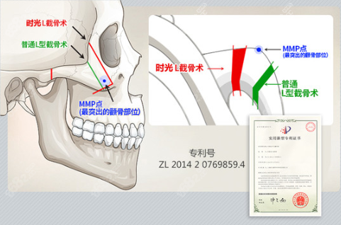 上海时光3D颧骨旋转截骨术