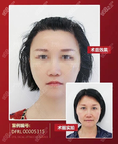 <!--<i data=20240705-sp></i>-->瑞丽李晓东psv效果图