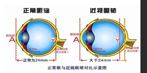 近视导致眼球外突的原因