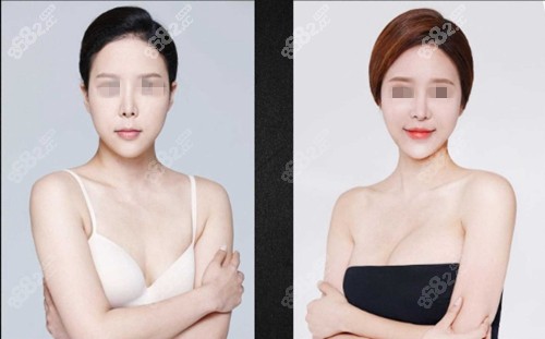 韩国必当归柳济圣假体丰胸前后对比图