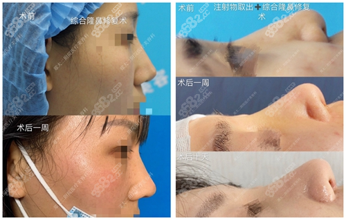 郑州大学第二附属医院李钢医生综合鼻修复真人对比效果图
