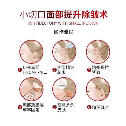 哈尔滨瑞丽整形做拉皮手术采用小切口