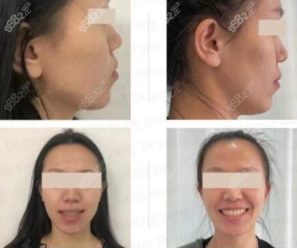 沈阳米兰口腔牙齿矫正真人前后对比照