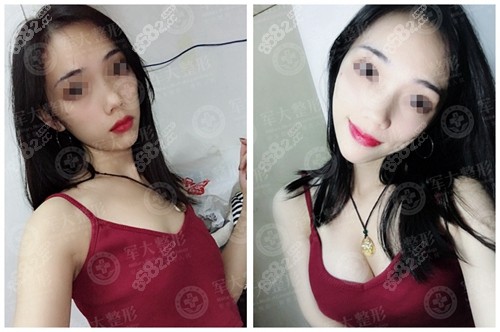 <!--<i data=20240705-sp></i>-->丰胸效果前后对比照片