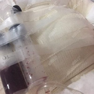 许做假体隆胸术后即刻