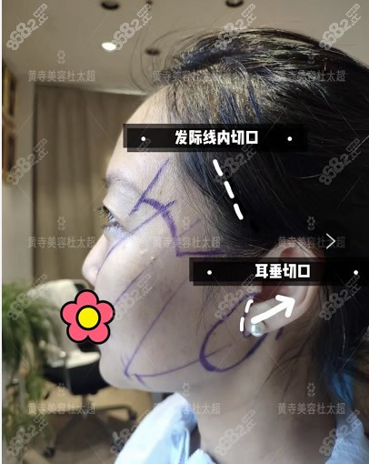 杜太超医生脸部小拉皮手术切口位置