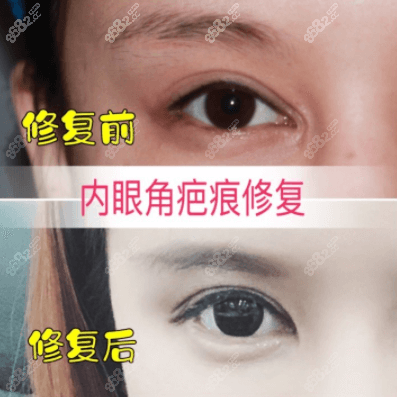 <!--<i data=20240705-sp></i>-->内眼角修复怎么样？我做的内眼角疤痕修复效果参考